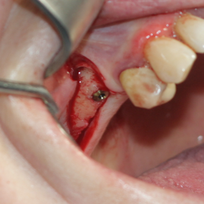 Поставен зъбен имплант