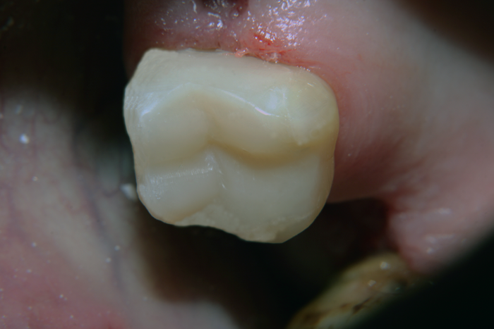 Зъбна реставрация